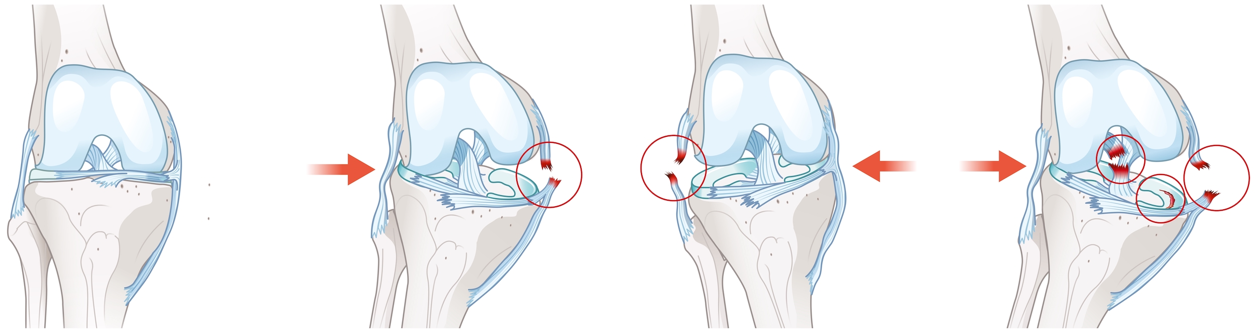 Kreuzbandverletzungen am Knie