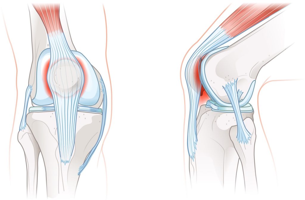 Patellainstabilität ist ein komplexes Zusammenspiel aus Band-, Knochen- und Achsproblemen.